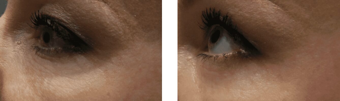 RAPID EYE LIFT